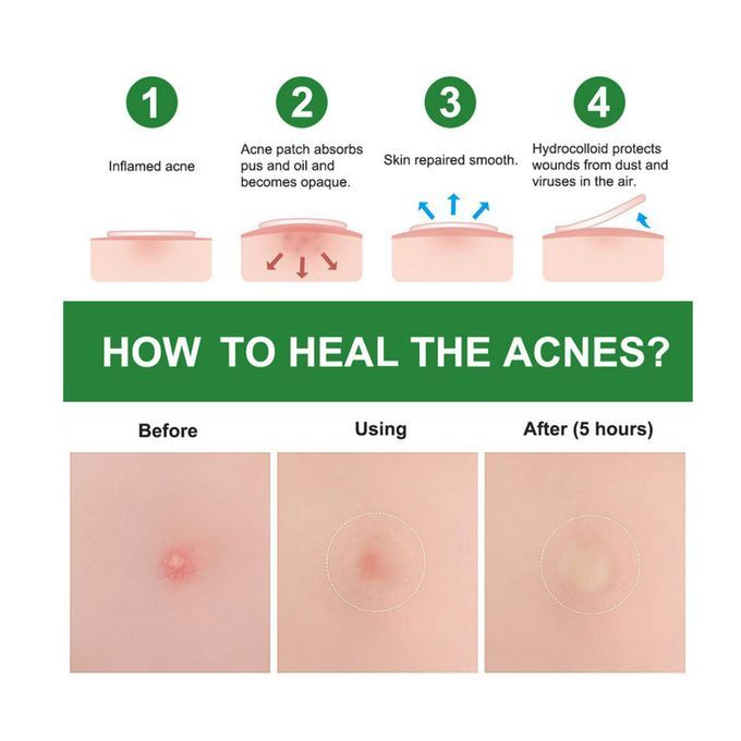 24 Patches Acne Pimple Patch Invisible Acne Removal