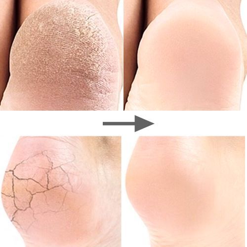 2 Pairs Silicone Heel Protectors Cushions Heel Cups For Plantar Fasciitis