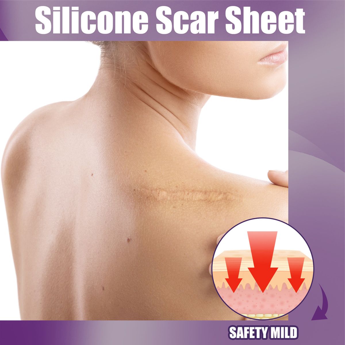 4Pcs Adhesive Silicone Scar Sheets Safety