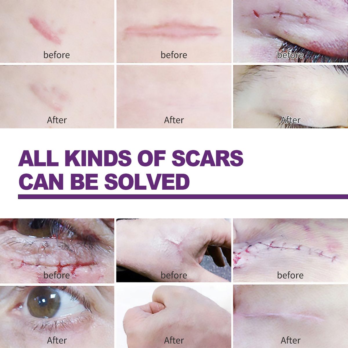 4Pcs Adhesive Silicone Scar Sheets Safety