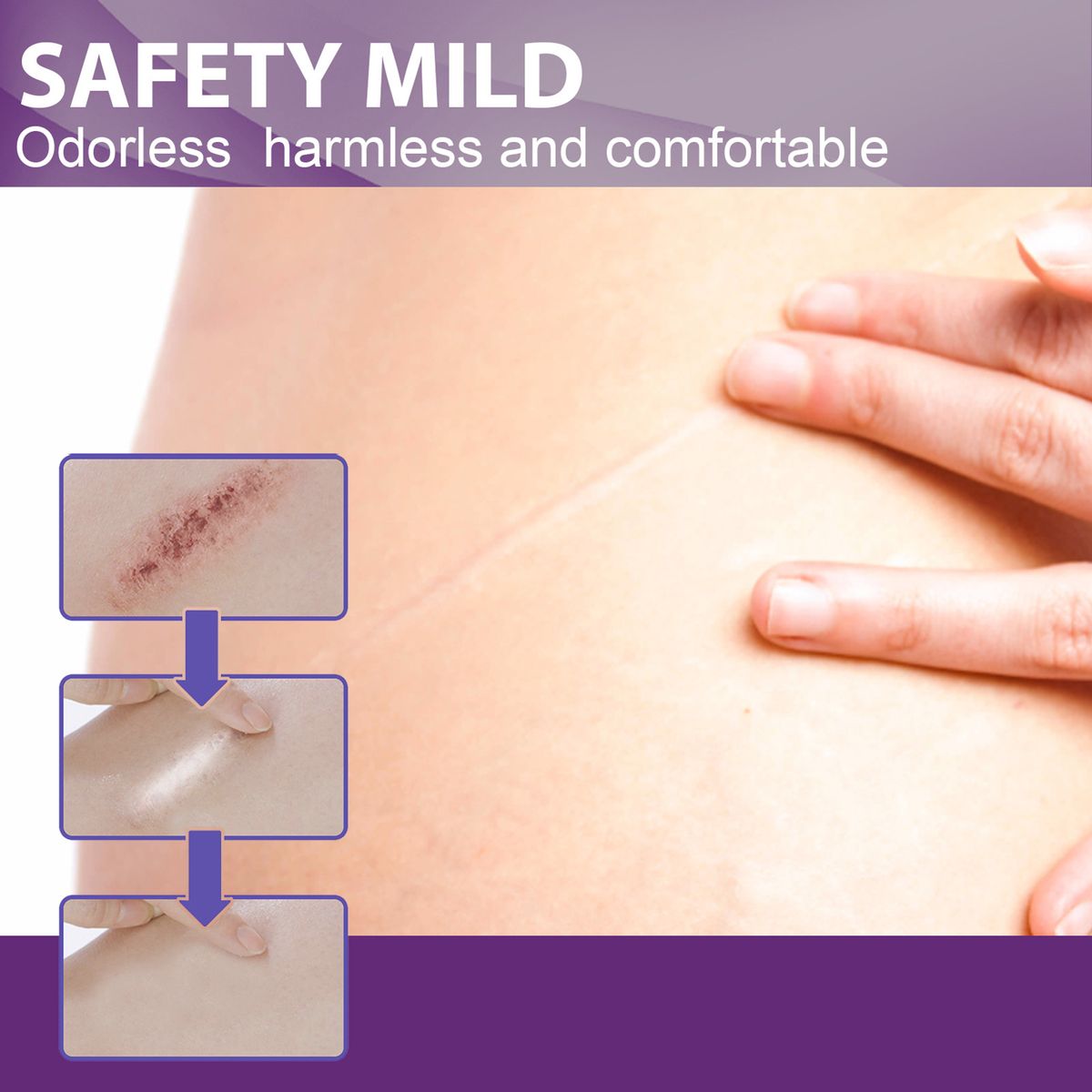 4Pcs Adhesive Silicone Scar Sheets Safety