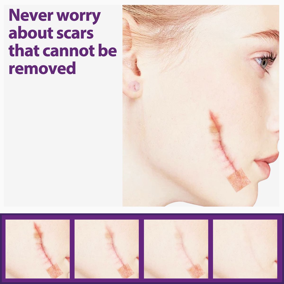 4Pcs Adhesive Silicone Scar Sheets Safety