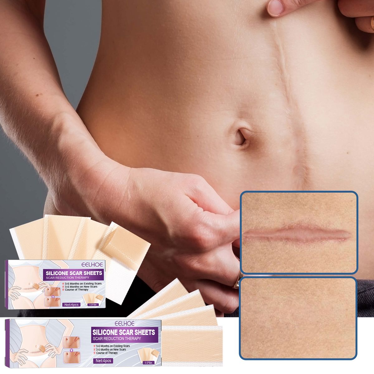 4Pcs Adhesive Silicone Scar Sheets Safety