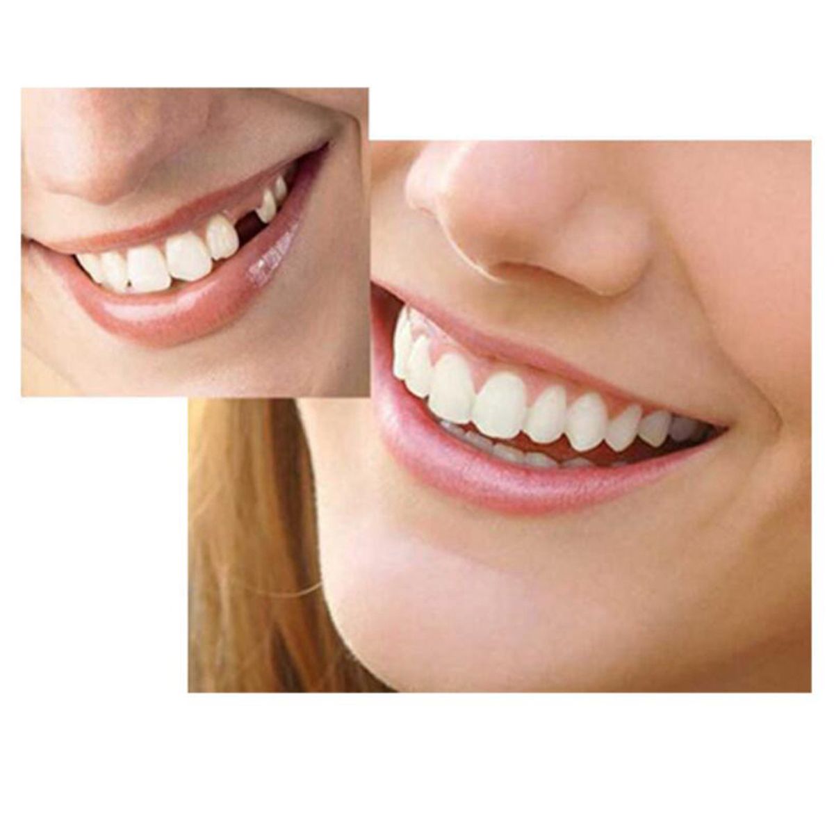 3pcs Teeth Veneers With 1 Bag Fitting Beads Temporary Teeth Snap On