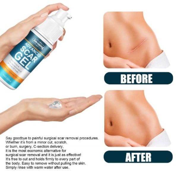 Jaysuing Advanced Scar Gel ,Scar Removal - 50ml
