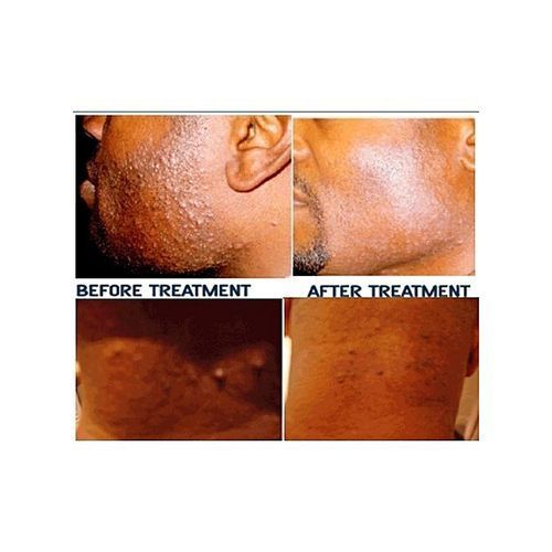 Anti-Bump Lotion - Bump Terminator - 120ml - 2 Bottle