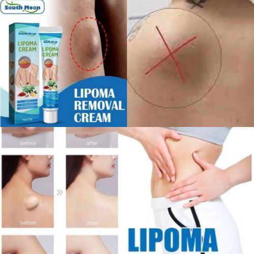 Fast Acting Lipoma Removal Ointment Cream