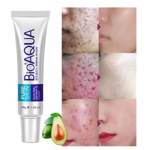 Acne Removal Cream - 30g