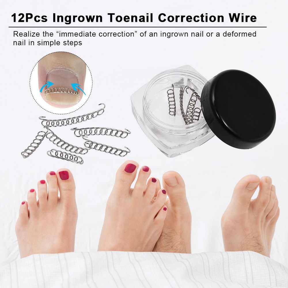 12Pcs Ingrown Toenail Correction Wire Fixer Ingrown Toe
