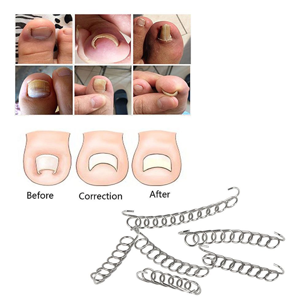 12Pcs Ingrown Toenail Correction Wire Fixer Ingrown Toe