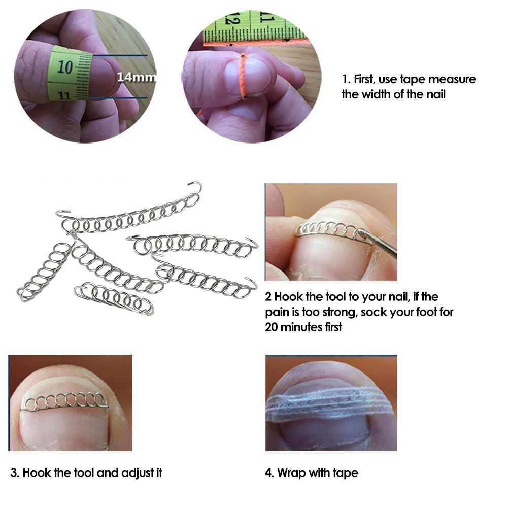 12Pcs Ingrown Toenail Correction Wire Fixer Ingrown Toe