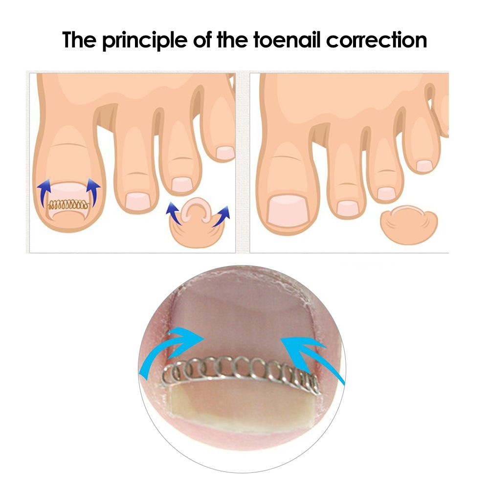 12Pcs Ingrown Toenail Correction Wire Fixer Ingrown Toe