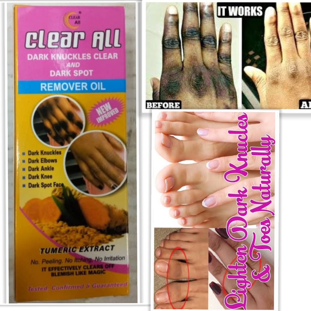 Clear All Dark Knuckles Clear And Dark Spot Remover Oil. 100% Effective