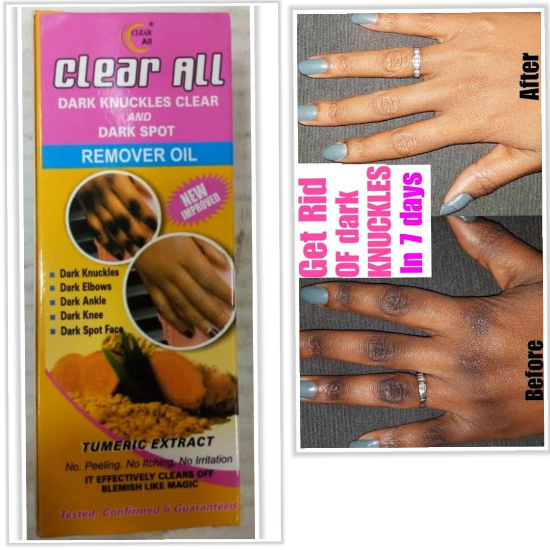 Clear All Dark Knuckles Clear And Dark Spot Remover Oil. 100% Effective