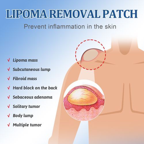 SOUTH MOON 12Pcs Lipoma Removal Patch Reduce Swelling Pain Relief