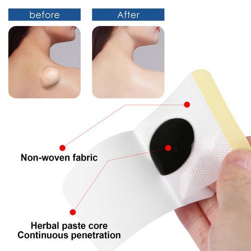 SOUTH MOON 12Pcs Lipoma Removal Patch Reduce Swelling Pain Relief