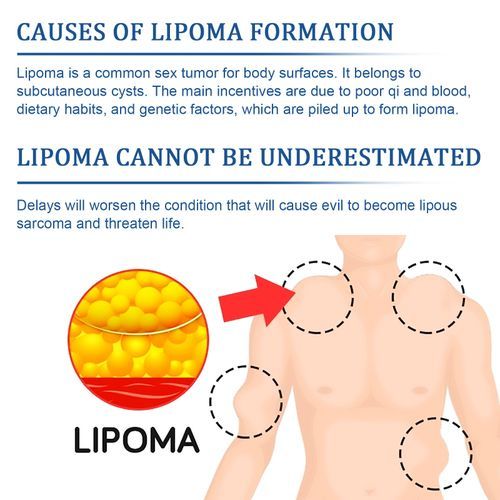 SOUTH MOON 12Pcs Lipoma Removal Patch Reduce Swelling Pain Relief