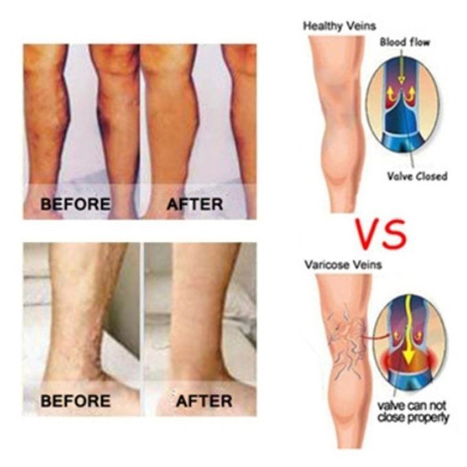 Alf  Ompression Sleeves Leg  Ompression So Ks Shin Splint  Alf Pain Relief-Skin