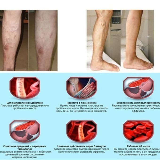 Alf  Ompression Sleeves Leg  Ompression So Ks Shin Splint  Alf Pain Relief-Skin