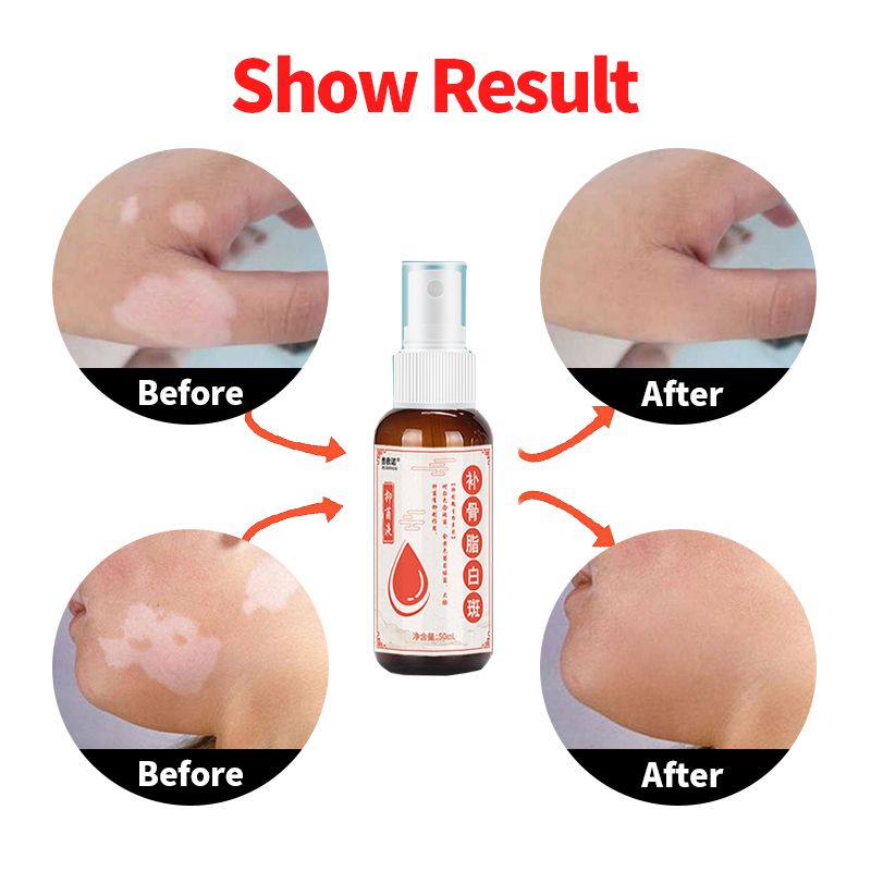 Spray Vitiligo Spray Foot Disease Repair Hand And Chinese Medical Liquid Hebal White Antibacterial Leukoplakia Treatment Spot