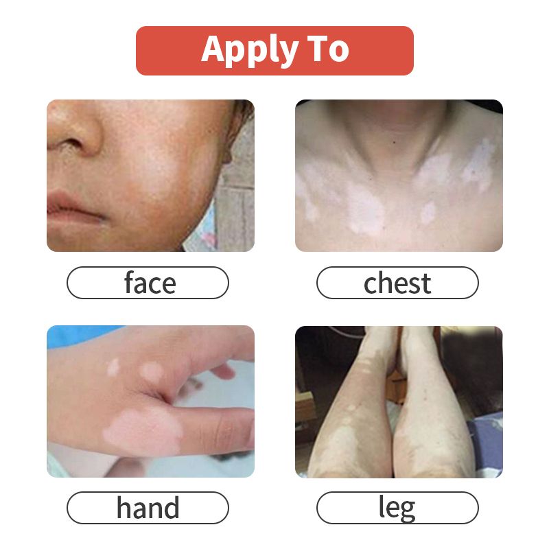 Spray Vitiligo Spray Foot Disease Repair Hand And Chinese Medical Liquid Hebal White Antibacterial Leukoplakia Treatment Spot