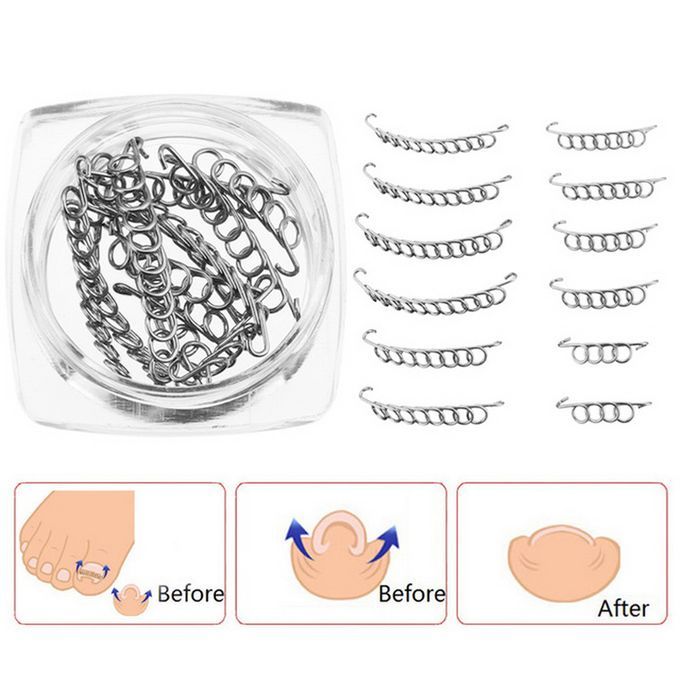 12Pcs/Box Ingrown Toenail Correction Wire Fixer 6 Sizes