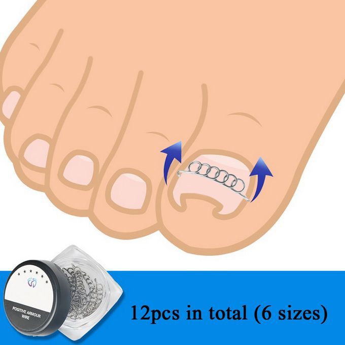 12Pcs/Box Ingrown Toenail Correction Wire Fixer 6 Sizes
