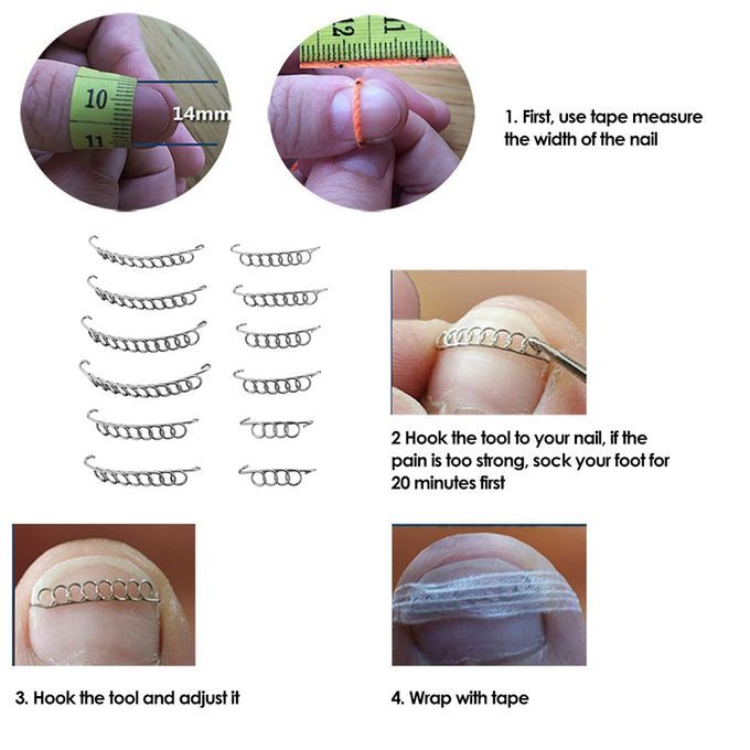 12Pcs/Box Ingrown Toenail Correction Wire Fixer 6 Sizes