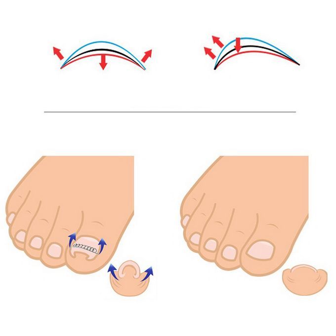 12Pcs/Box Ingrown Toenail Correction Wire Fixer 6 Sizes