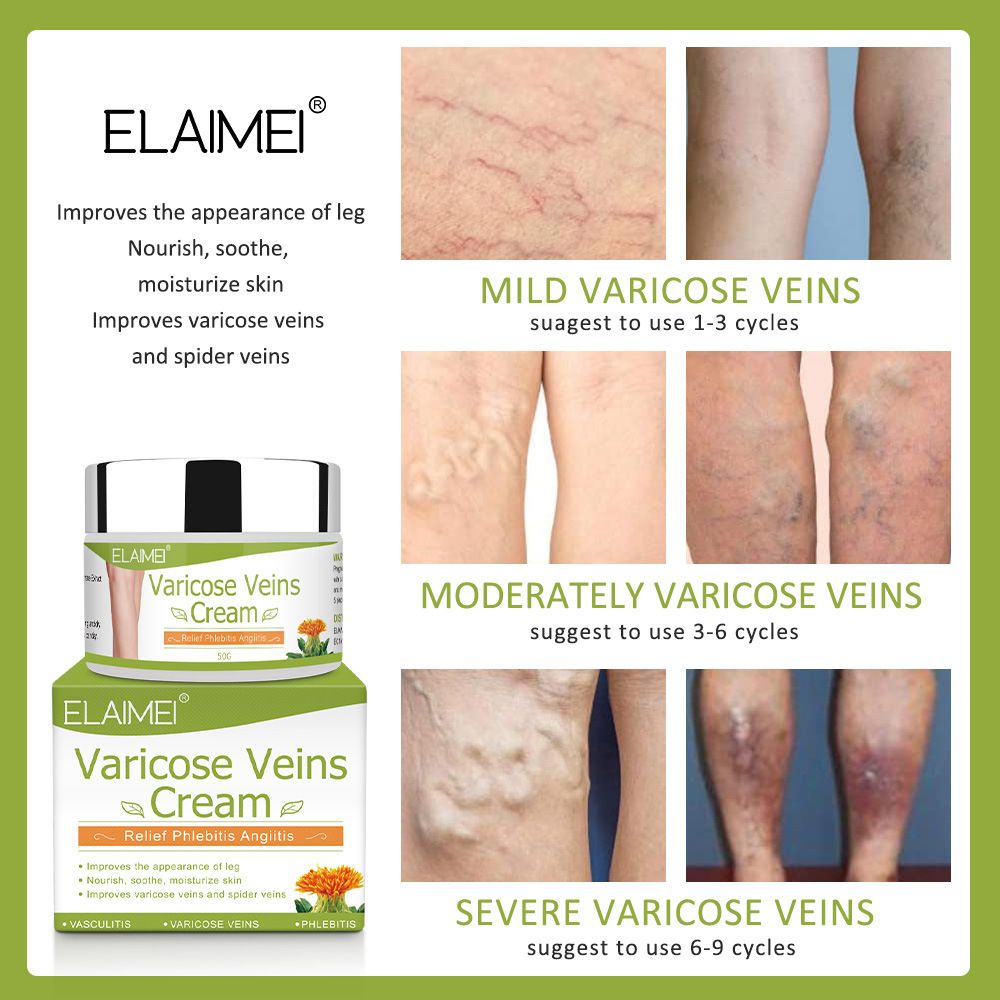 Varicose Veins Cream Natural Treatment Chinese Herbal Cream