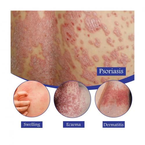 Psoriasis Relief Spray X 2