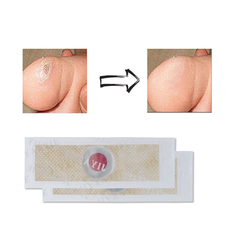 Callus Plaster Soften Feet C584 Warts Care Feet Tool 40Pcs/Box Thorn Painless Patch Skin Foot Cutin Remover Medical Corn Removal