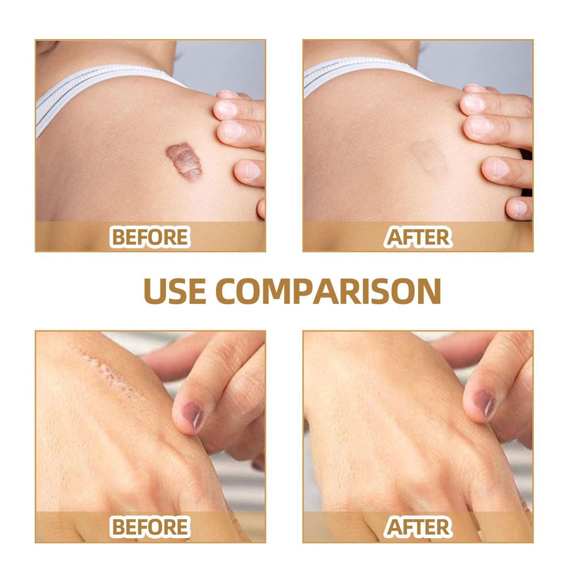 JAYSUING 60 Patches Scar Tattoo Scald Silicone Covering Patch Skin Invisible Concealer Sticker Breathable Comfortable