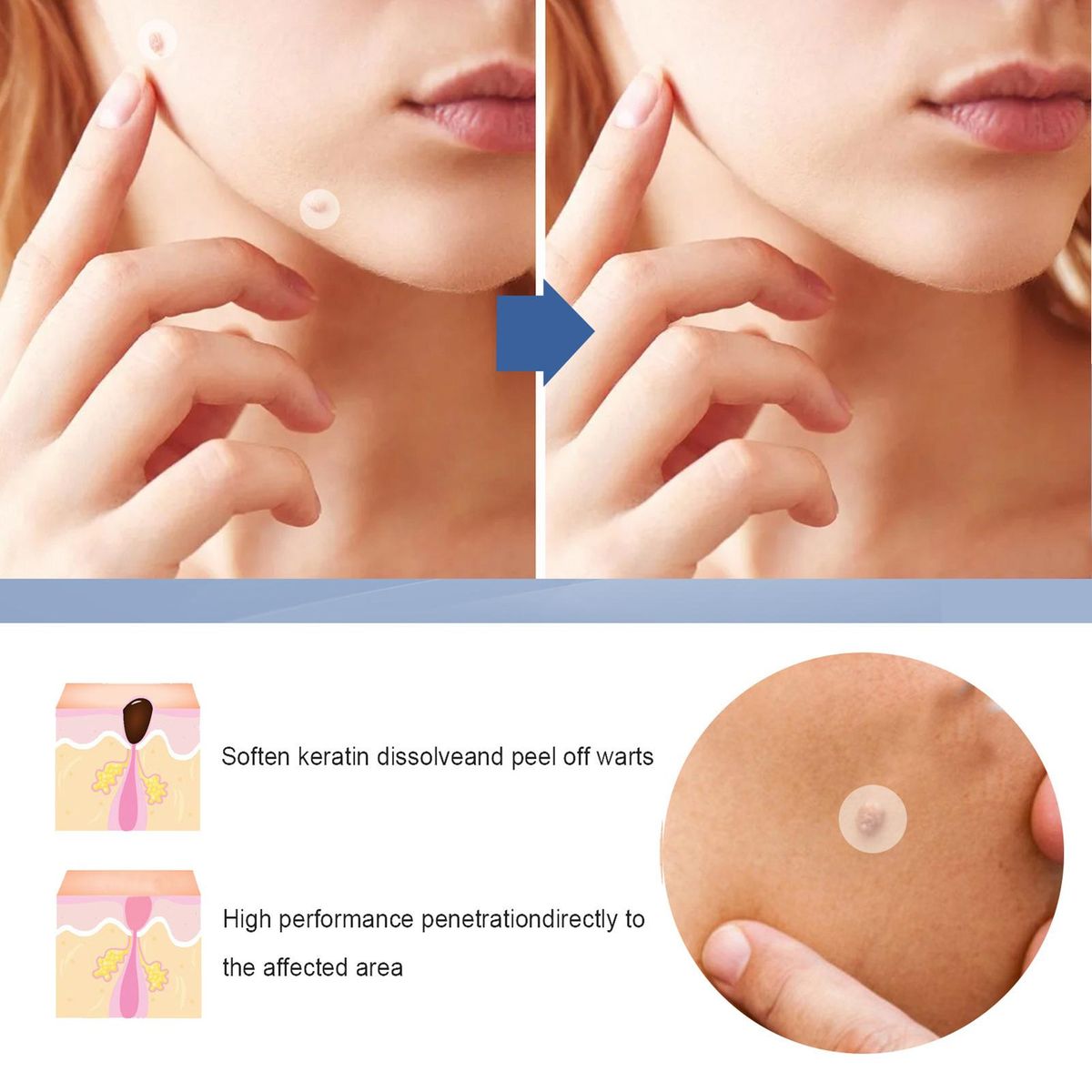 EELHOE Skin T-ag Remover Patches Mole Wart Removing Sticker Natural Ingredients 144PCS