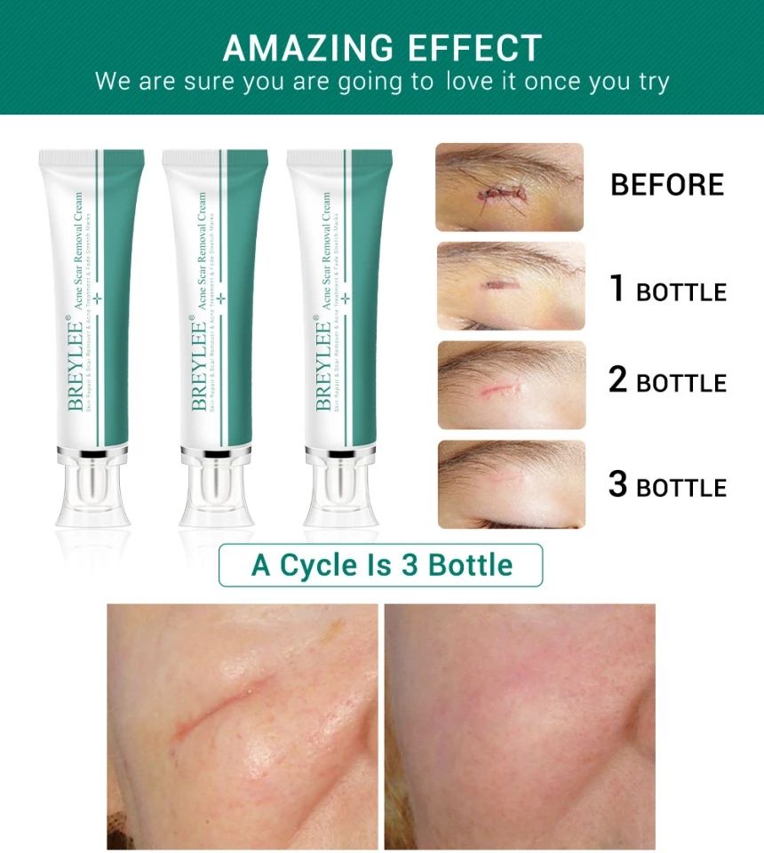 Breylee Acne Scar Removal Cream. - Skin Repair And Scar Remover / Acne Treatment / Stretch Mark Cream