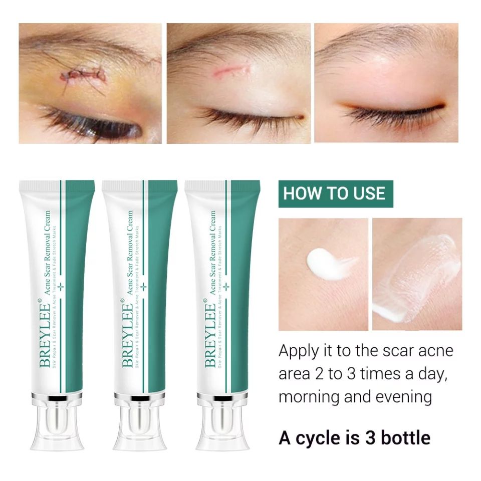 Breylee Acne Scar Removal Cream. - Skin Repair And Scar Remover / Acne Treatment / Stretch Mark Cream