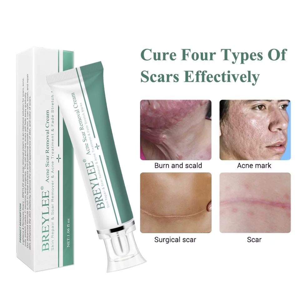 Breylee Acne Scar Removal Cream. - Skin Repair And Scar Remover / Acne Treatment / Stretch Mark Cream