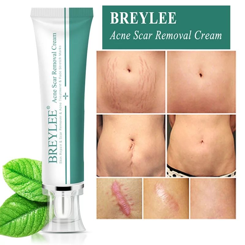 Breylee Acne Scar Removal Cream. - Skin Repair And Scar Remover / Acne Treatment / Stretch Mark Cream