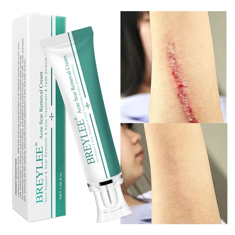 Breylee Acne Scar Removal Cream. - Skin Repair And Scar Remover / Acne Treatment / Stretch Mark Cream