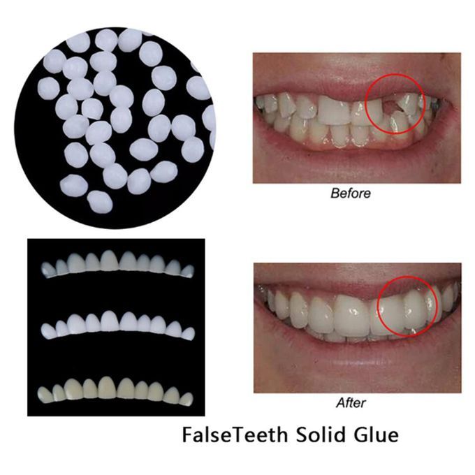 3pcs Denture Teeth Veneers With Thermal Fitting Beads Temporary