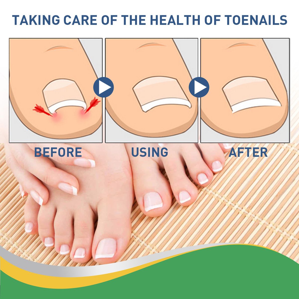 50pcs/Box Ingrown Toenail Sticker Toenail