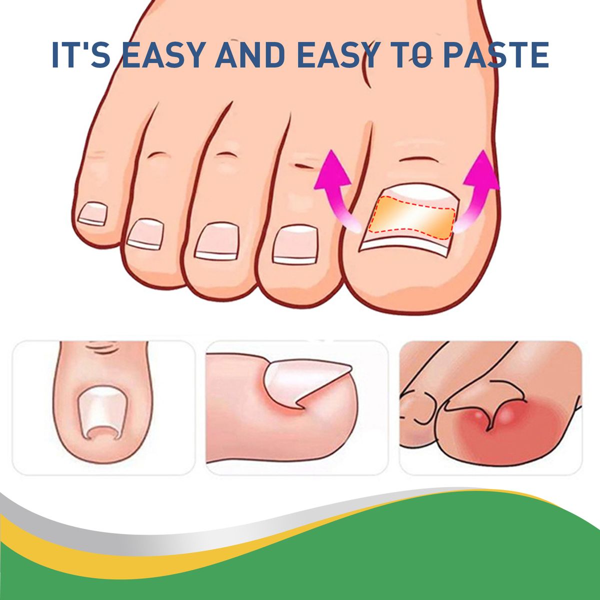 50pcs/Box Ingrown Toenail Sticker Toenail