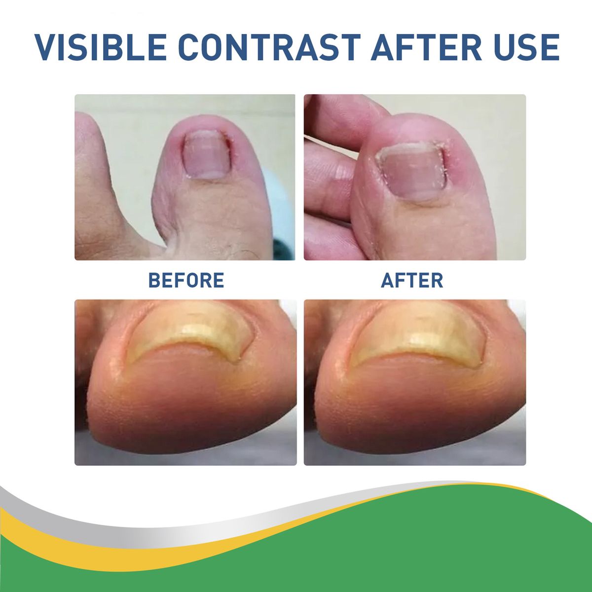 50pcs/Box Ingrown Toenail Sticker Toenail
