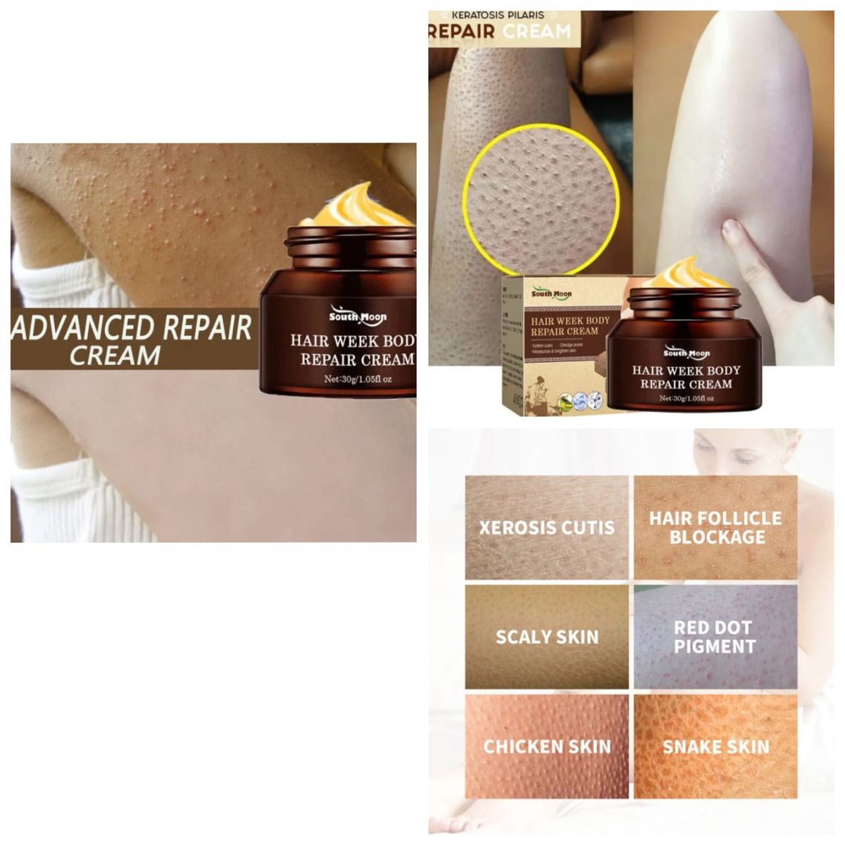Keratosis Pilaris, Chicken/strawberry  Skin Goose Bump Removal Cream