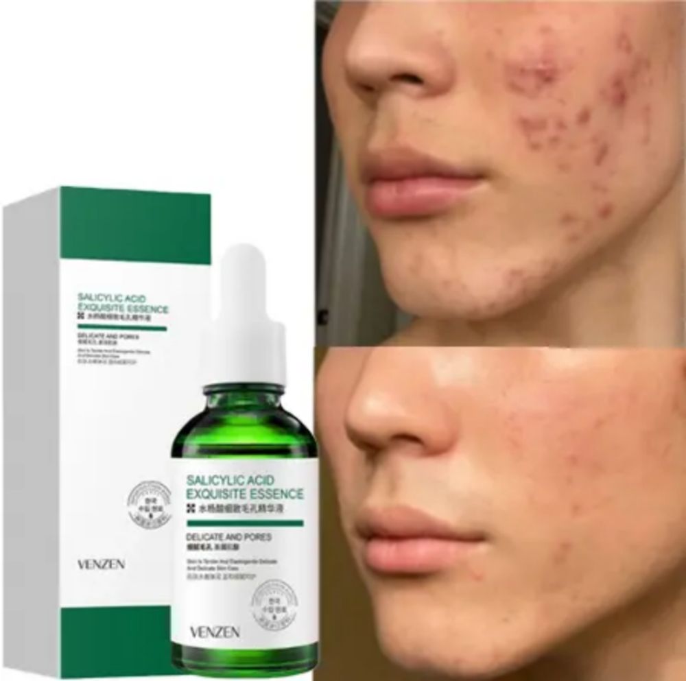 Salicylic Acid Acne Treatment   Face Serum +Hyaluronic Acid