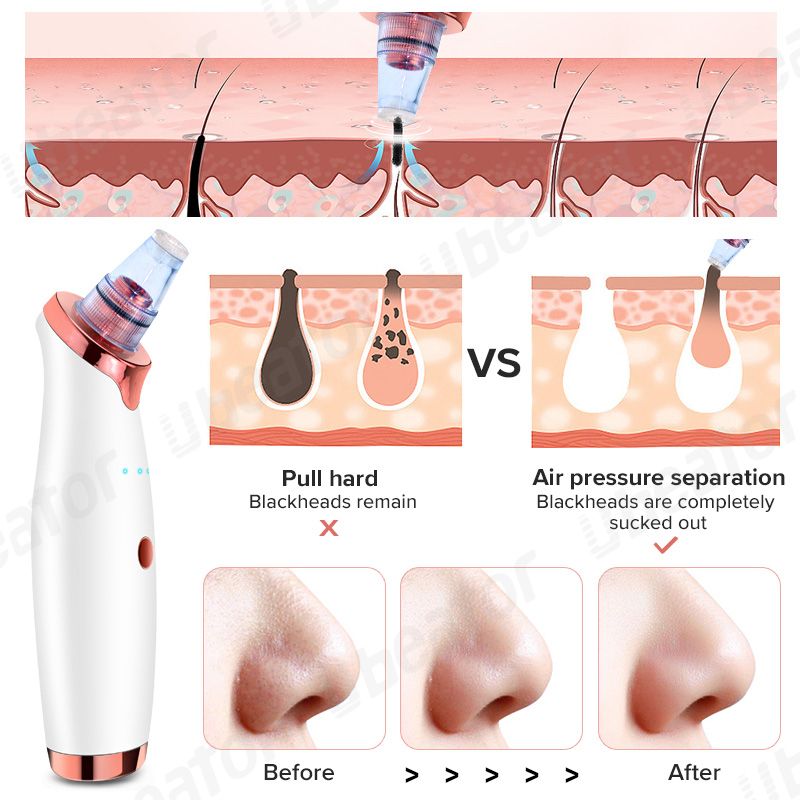 USB Charging Vacuum Suction Blackhead Remover For Nose,Facial Pore Acne Grease Cleaner Skin Care-A5