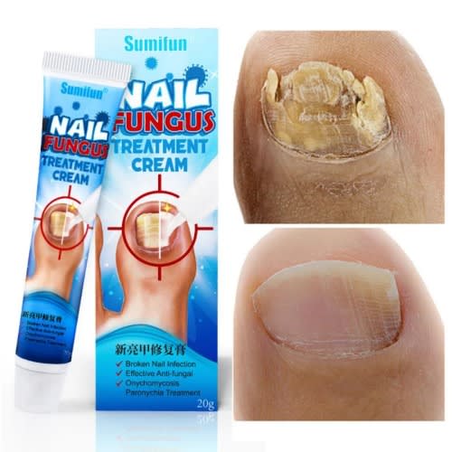 20g Sumifun Nail Fungus Treatment Cream | Nail Infection Cream