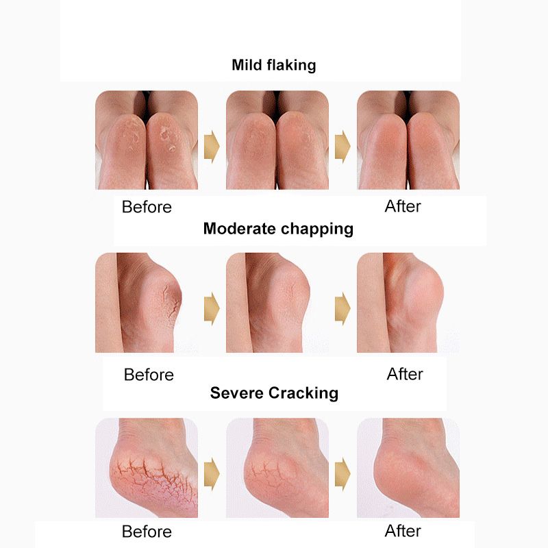 Silicone Heel Anti-crack Protective Cover Anti-heel Dry