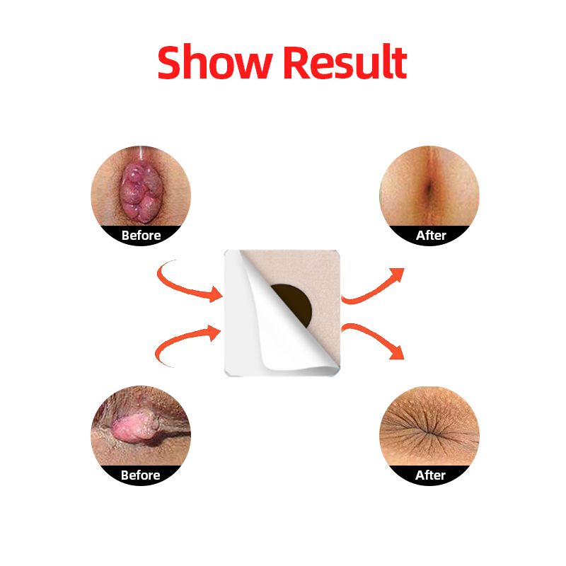 Hemorrhoid Medical Cause Hemorrhoids Treatment Mixed Patch Chinese Pain Hemorrhoid Anal Herbal Cream Stool