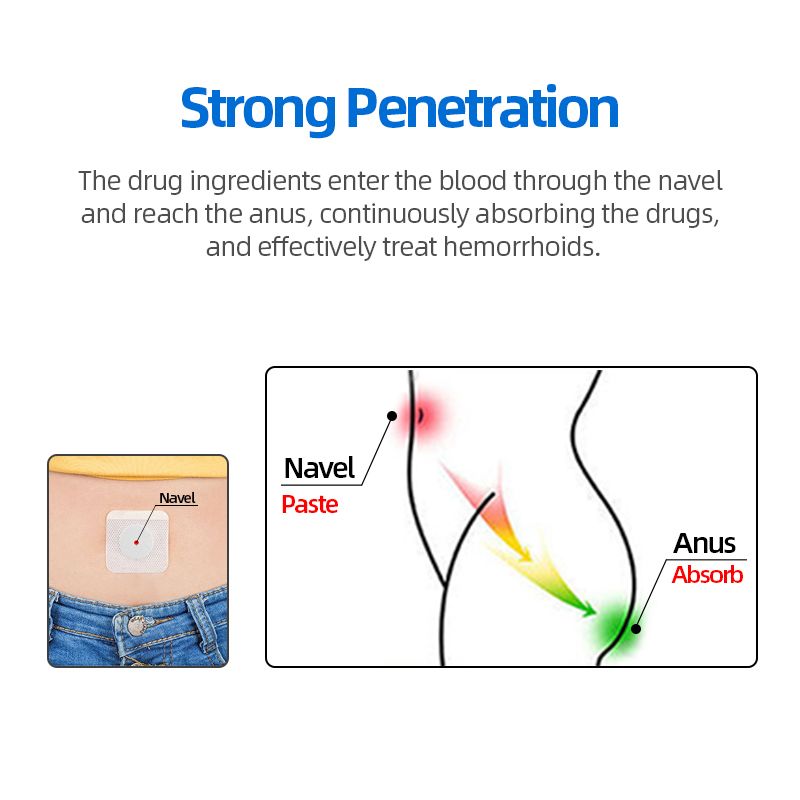 Hemorrhoid Medical Cause Hemorrhoids Treatment Mixed Patch Chinese Pain Hemorrhoid Anal Herbal Cream Stool
